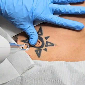 Laser Tattoo Removal Miami